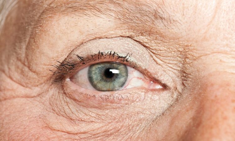 macular degeneration