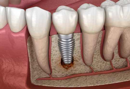 failing teeth